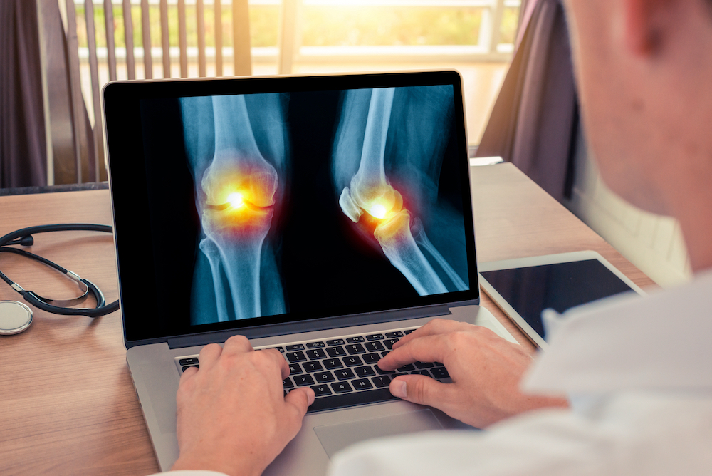 Doctor watching a laptop with x-ray of legs with pain in the knee.