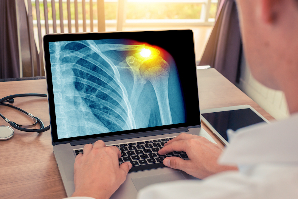 Doctor watching a laptop with x-ray of a chest with pain in the shoulder.